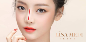 Nâng mụi tại lisa medi