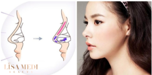 Nâng mũi Hàn Quốc tại LISA